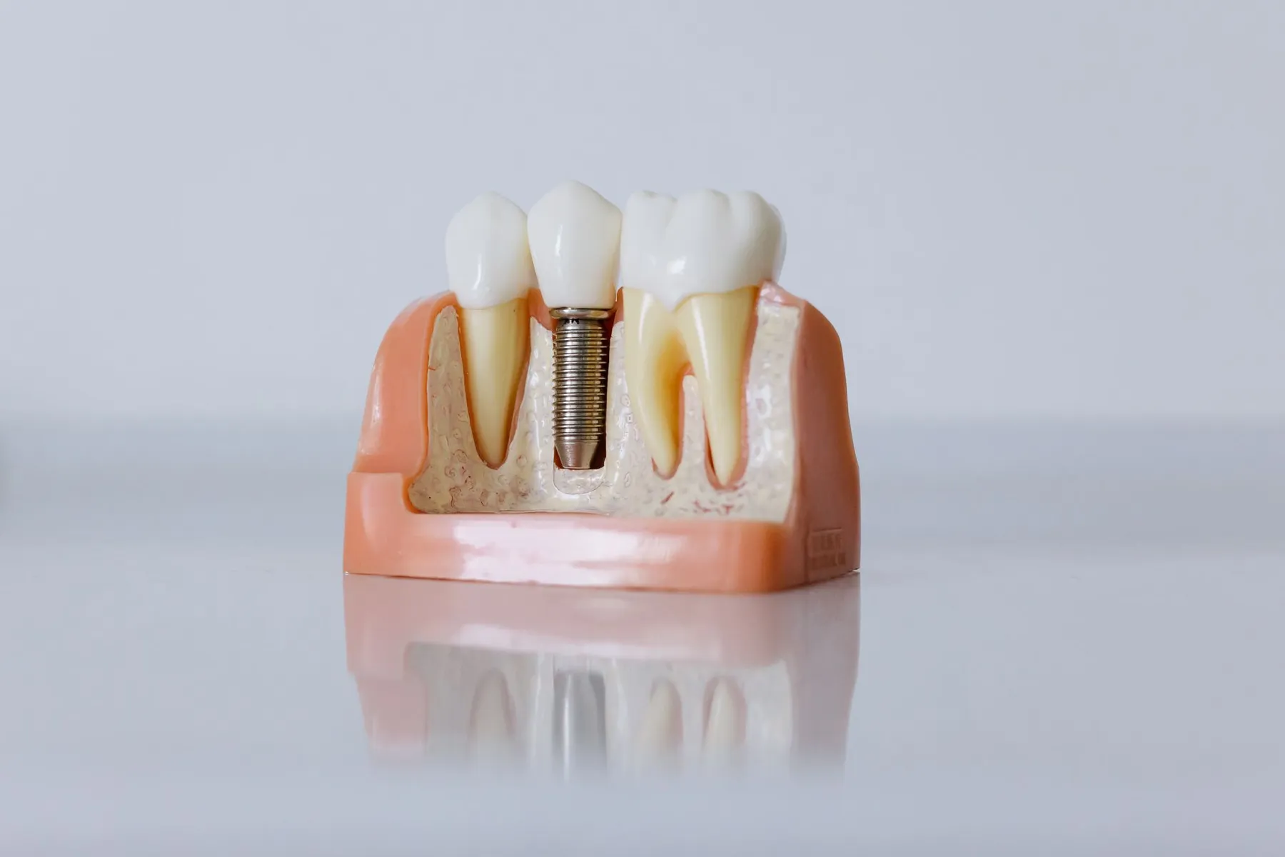A dental implant model showing a titanium post between two natural teeth