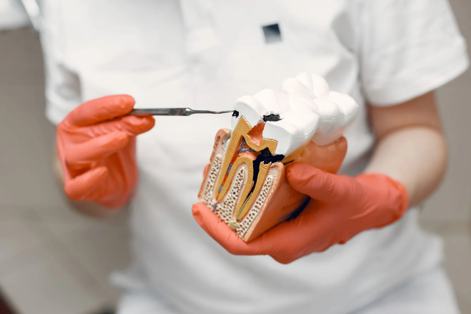 A dental model showing the inside of a tooth during root canal treatment